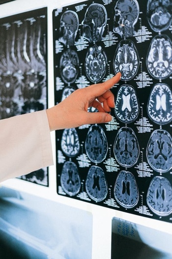 Premian un trabajo sobre detección precoz de alzhéimer con IA